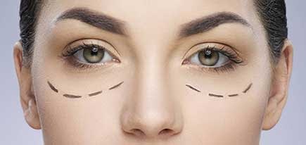 Cosmetic - eyelid lift surgery london