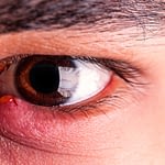When Your Eyelids Are Inflamed — Blepharitis